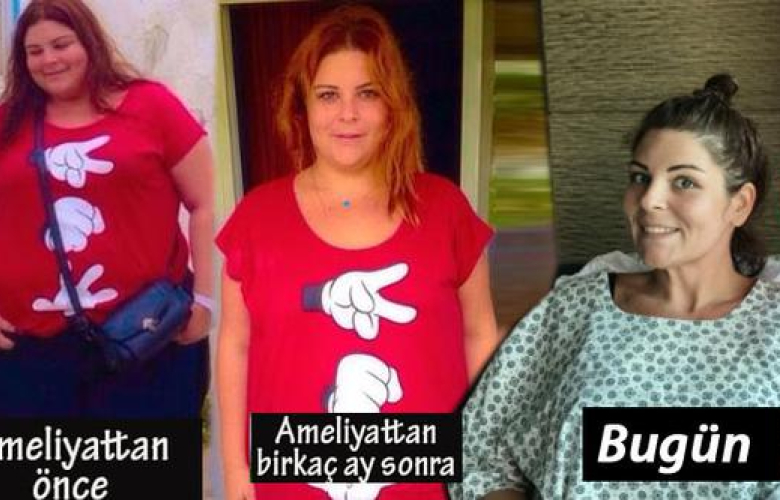 22 ayda 90 kilo veren Pelin Öztekin yeniden ameliyat oldu!
