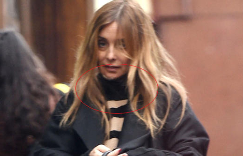 Görünmez kaza: Çenesi dağıldı