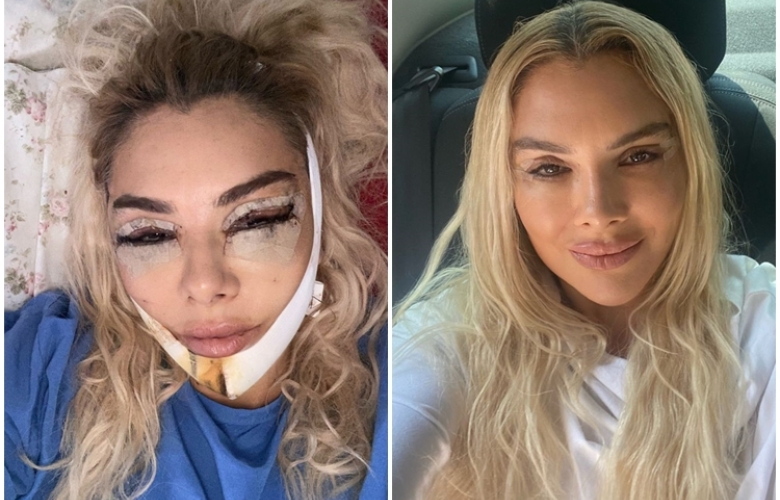 Son trend estetik ameliyat sonrası fotoğraf paylaşmak! Son fotoğraf  Meltem Eren'den geldi! 